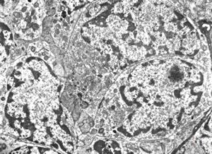 M,2y. | nephroblastoma (Wilms tumor) M,2y. | nephroblastoma (Wilms tumor)